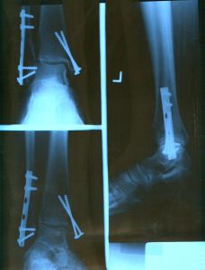 ankle-x-ray-124731-m.jpg