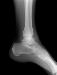 ankle-x-ray-blog-june-4.jpg